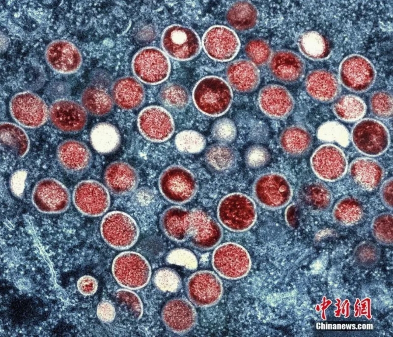 资料图：猴痘颗粒的彩色透射电子显微图。.png